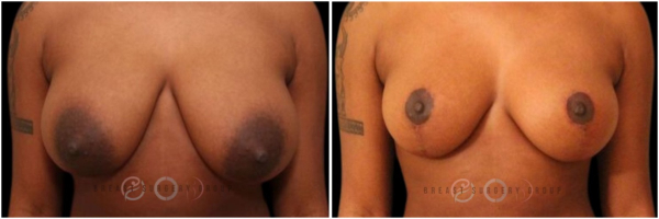 breast-reduction-nyc-before-and-after-10