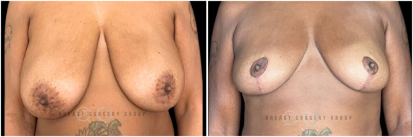 breast-reduction-nyc-before-and-after-11