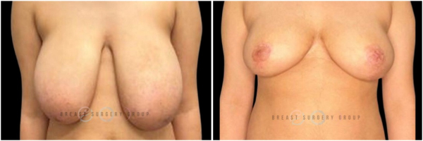 breast-reduction-nyc-before-and-after-12