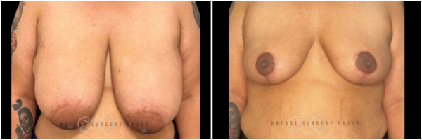 breast-reduction-nyc-before-and-after-13