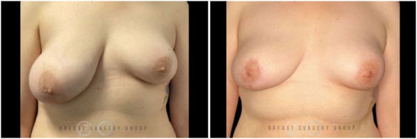 breast-reduction-nyc-before-and-after-kb-15