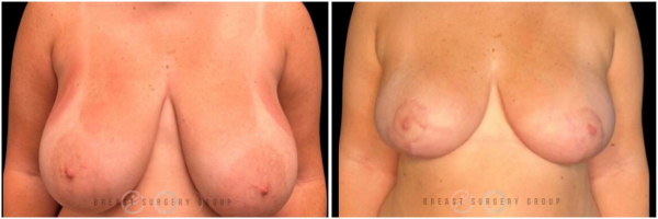 breast-reduction-nyc-before-and-after-kb-16