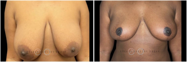 breast-reduction-nyc-before-and-after-kb-17