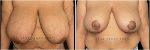 breast-reduction-nyc-before-and-after-kb-18