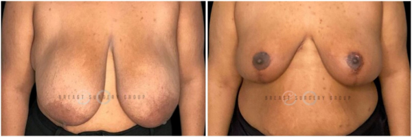 breast-reduction-nyc-before-and-after-kb-19