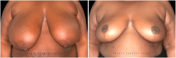 breast-reduction-nyc-before-and-after-kb-20