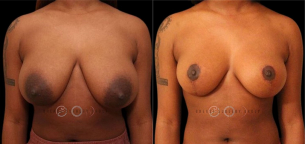 breast-reduction-nyc-before-and-after-kb-br-1