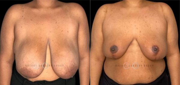 breast-reduction-nyc-before-and-after-kb-br-10