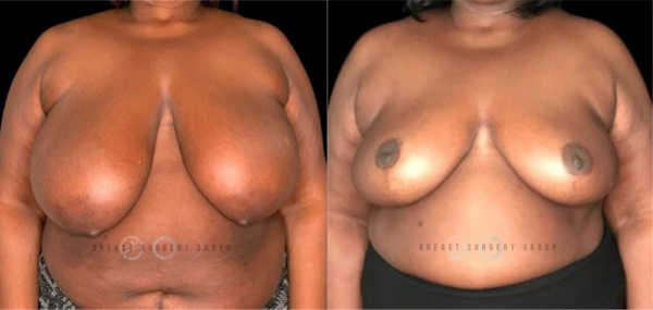 breast-reduction-nyc-before-and-after-kb-br-11