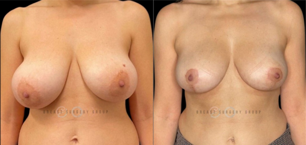 breast-reduction-nyc-before-and-after-kb-br-13