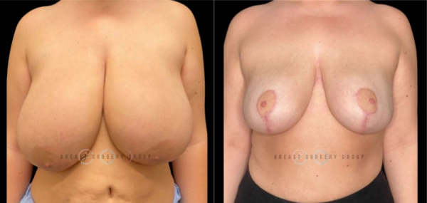 breast-reduction-nyc-before-and-after-kb-br-14