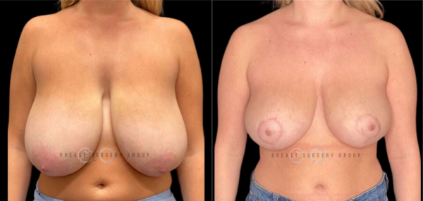 breast-reduction-nyc-before-and-after-kb-br-15