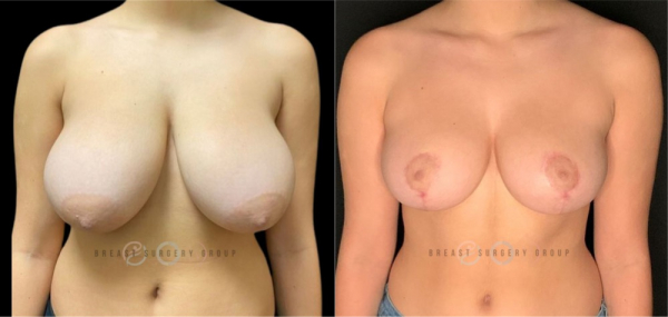 breast-reduction-nyc-before-and-after-kb-br-17