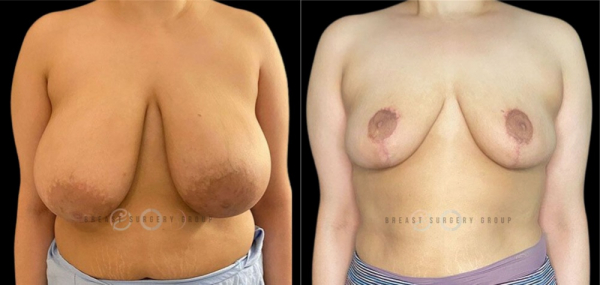 breast-reduction-nyc-before-and-after-kb-br-18