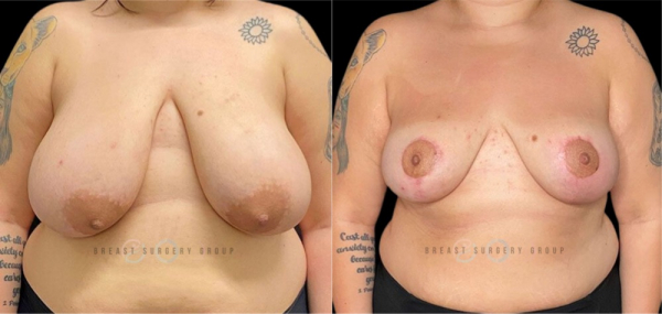 breast-reduction-nyc-before-and-after-kb-br-19