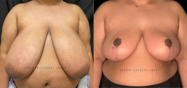 breast-reduction-nyc-before-and-after-kb-br-20