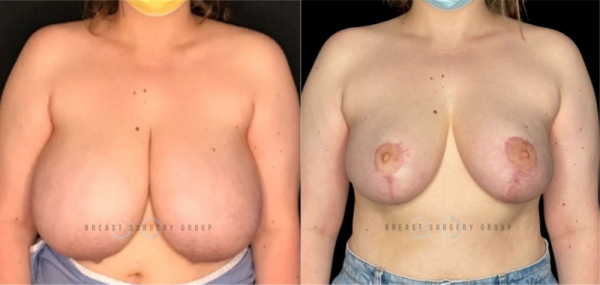 breast-reduction-nyc-before-and-after-kb-br-21