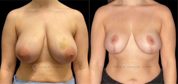 breast-reduction-nyc-before-and-after-kb-br-22