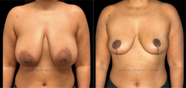 breast-reduction-nyc-before-and-after-kb-br-23