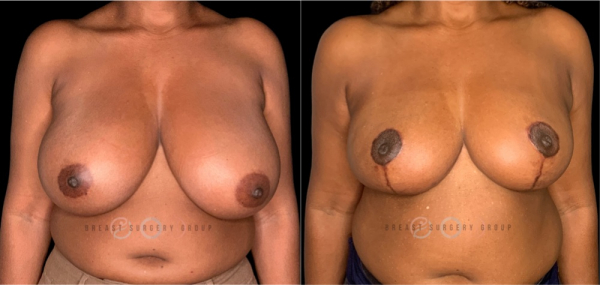 breast-reduction-nyc-before-and-after-kb-br-24-1