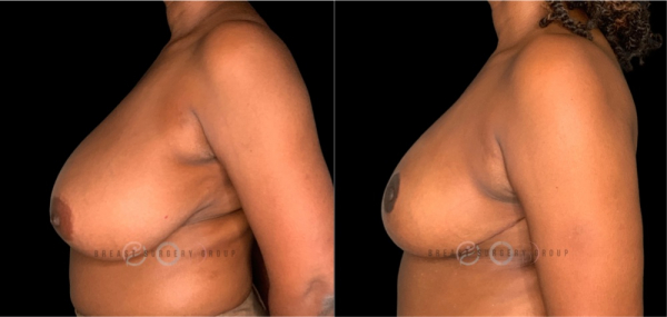 breast-reduction-nyc-before-and-after-kb-br-24-2