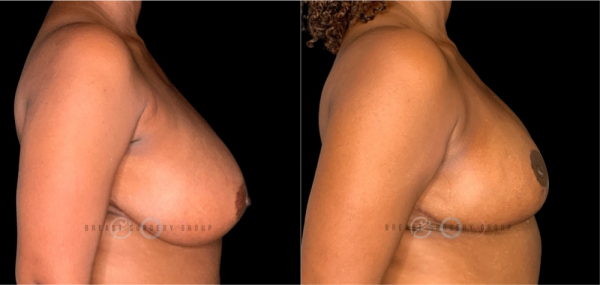 breast-reduction-nyc-before-and-after-kb-br-24-3