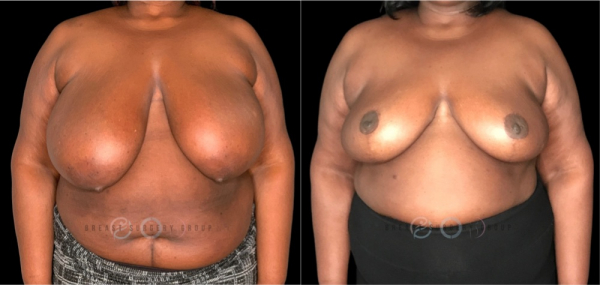 breast-reduction-nyc-before-and-after-kb-br-25-1