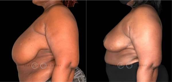 breast-reduction-nyc-before-and-after-kb-br-25-2