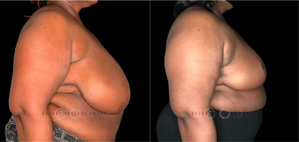 breast-reduction-nyc-before-and-after-kb-br-25-3