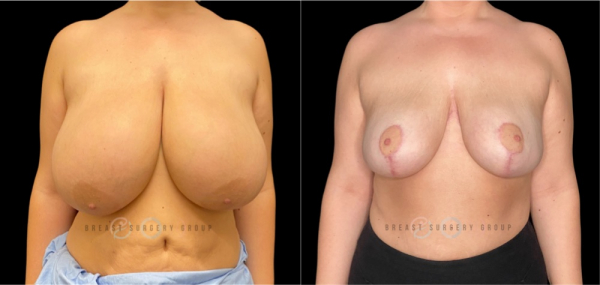 breast-reduction-nyc-before-and-after-kb-br-26-1