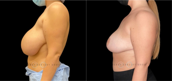 breast-reduction-nyc-before-and-after-kb-br-26-2