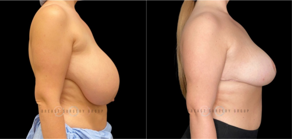 breast-reduction-nyc-before-and-after-kb-br-26-3