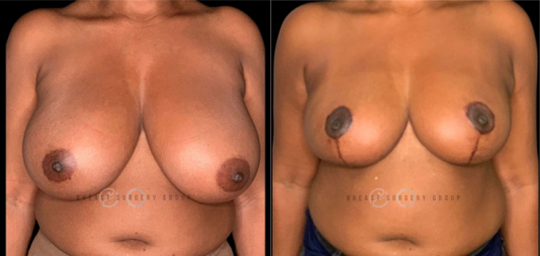 breast-reduction-nyc-before-and-after-kb-br-5