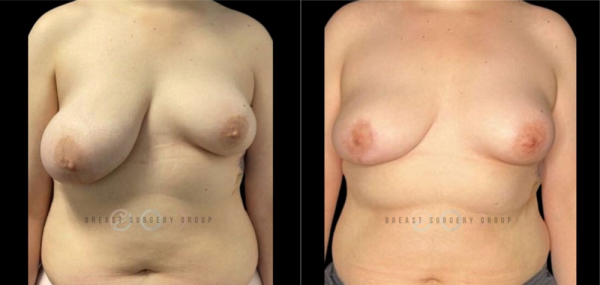 breast-reduction-nyc-before-and-after-kb-br-6