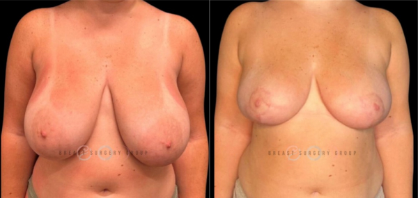 breast-reduction-nyc-before-and-after-kb-br-7