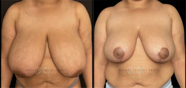 breast-reduction-nyc-before-and-after-kb-br-9