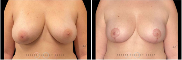 breast-reduction-nyc-plastic-surgery-before-and-after-kb-21