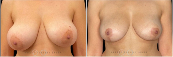 breast-reduction-nyc-plastic-surgery-before-and-after-kb-22