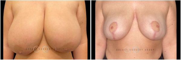 breast-reduction-nyc-plastic-surgery-before-and-after-kb-23