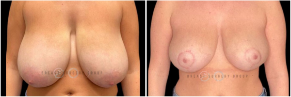 breast-reduction-nyc-plastic-surgery-before-and-after-kb-24