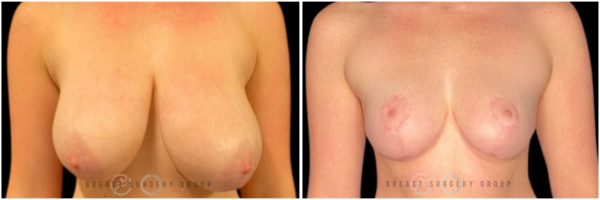 breast-reduction-nyc-plastic-surgery-before-and-after-kb-25