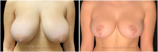 breast-reduction-nyc-plastic-surgery-before-and-after-kb-26