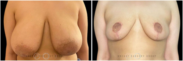 breast-reduction-nyc-plastic-surgery-before-and-after-kb-27