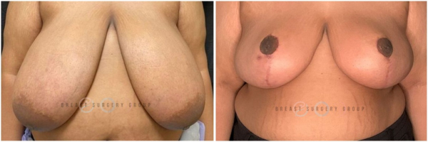 breast-reduction-nyc-plastic-surgery-before-and-after-kb-29