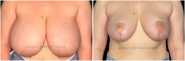 breast-reduction-nyc-plastic-surgery-before-and-after-kb-30