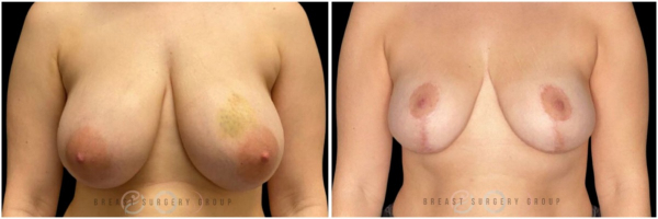 breast-reduction-nyc-plastic-surgery-before-and-after-kb-31