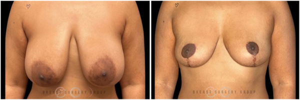 breast-reduction-nyc-plastic-surgery-before-and-after-kb-32